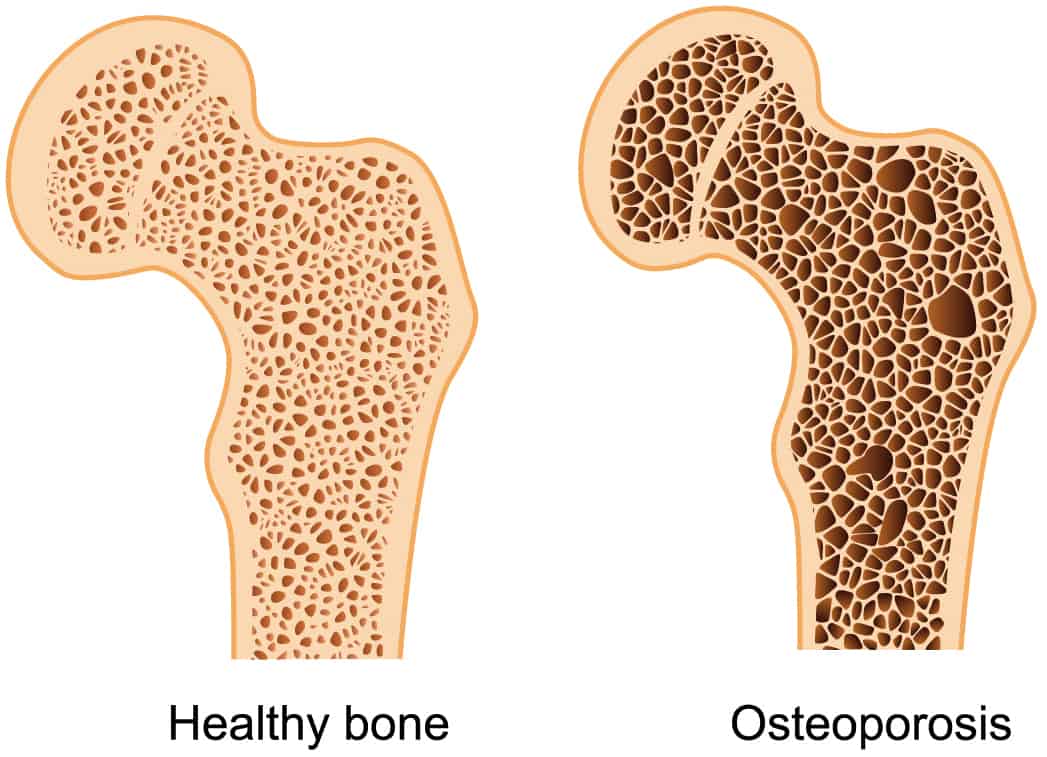 bone-density-what-it-is-and-how-to-keep-what-you-ve-got-hss